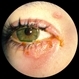 Herpes Simplex Infection of Lids Herpes Simplex Infection of Lids