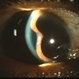 Iris Bombe with Rubeosis Iris Bombe with Rubeosis