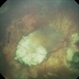Group D Retinoblastoma After Chemo and Laser