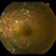 Hypertensive Retinopathy Hypertensive Retinopathy