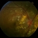 Hypertensive Retinopathy Hypertensive Retinopathy