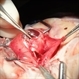 Open Globe Injury with Corneal Scleral Laceration