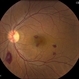 HIV Hemorrhage