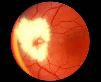 bear tracks retina treatment