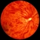 Central Retinal Vein Occlusion
