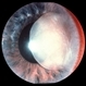 Traumatic Lens Dislocation