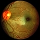 Cilioretinal Artery Occlusion