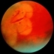 Cryo-Retinal Tear