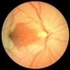 Central Retinal Artery Occlusion Sparing Macula