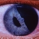 Traumatic Iridodialysis