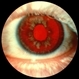 Albinism Albinism