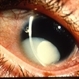 Aniridia and Dislocated Lens Aniridia and Dislocated Lens