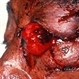Knife Stabbing Enucleation Knife Stabbing Enucleation