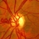 Anomalous Vein Off Disc Anomalous Vein Off Disc