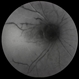 Severe Non-Perfusion Diabetes Severe Non-Perfusion Diabetes