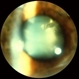 Foreign Body In Lens Foreign Body In Lens