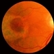 Chloroquine Maculopathy Chloroquine Maculopathy