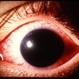 Black Ball Hyphema Black Ball Hyphema