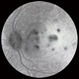 Sympathetic Ophthalmia after Vitrectomy Sympathetic Ophthalmia after Vitrectomy