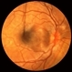 Sympathetic Ophthalmia after Vitrectomy Sympathetic Ophthalmia after Vitrectomy
