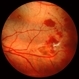 Peripheral Tear