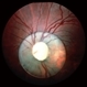 Traumatic Lens Dislocation Over Disc Traumatic Lens Dislocation Over Disc