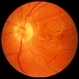 Neuroretinitis Neuroretinitis
