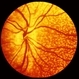 Fundus Albipunctatus Fundus Albipunctatus