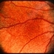 Fundus Albipunctatus