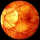 Myopic Degeneration Myopic Degeneration
