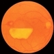 Subhyaloid Hemorrhage, Hypopyon Subhyaloid Hemorrhage, Hypopyon