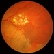 Macroaneurysm Macroaneurysm