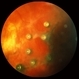 Retinal Tacks Retinal Tacks