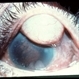 Traumatic Lens Dislocation, Extraocular Traumatic Lens Dislocation, Extraocular