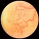 Retinopathy of Prematurity Retinopathy of Prematurity