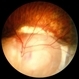 Coloboma