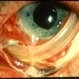 Extruded Scleral Buckle Extruded Scleral Buckle