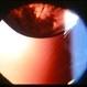 Ectopia Lentis with Zonules Visible Ectopia Lentis with Zonules Visible