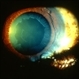 Pseudoexfoliation of Lens Capsule