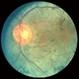 Toxic Retinopathy