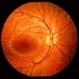 Canthoxanthene Maculopathy