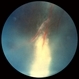 Sarcoid Vasculitis Sarcoid Vasculitis