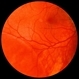 Retinoschisis