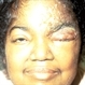 Herpes Zoster of Face Herpes Zoster of Face