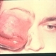 Rhabdomyosarcoma Rhabdomyosarcoma