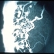 Retinopathy of Prematurity Stage 3 Retinopathy of Prematurity Stage 3