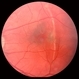 Choroidal Rupture Across Macula Choroidal Rupture Across Macula