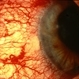 Carotid-Cavernous Fistula Carotid-Cavernous Fistula