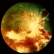 Cytomegalovirus Retinitis Cytomegalovirus Retinitis