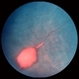 Sickle Salmon-Patch Hemorrhage Sickle Salmon-Patch Hemorrhage